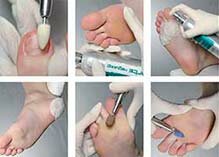 О аппаратном педикюре o-apparatnom-pedikyure